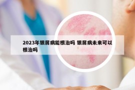 2023年銀屑病能根治嗎 銀屑病未來可以根治嗎