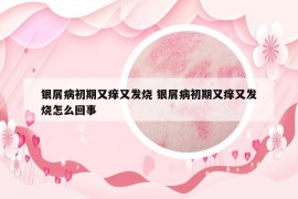 銀屑病初期又癢又發(fā)燒 銀屑病初期又癢又發(fā)燒怎么回事