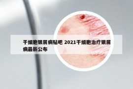 干細胞銀屑病貼吧 2021干細胞治療銀屑病最新公布
