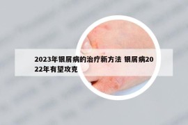 2023年銀屑病的治療新方法 銀屑病2022年有望攻克