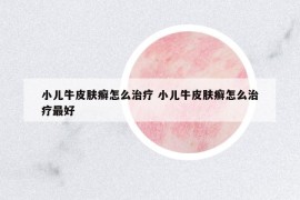 小兒牛皮膚癬怎么治療 小兒牛皮膚癬怎么治療最好