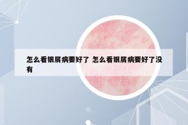怎么看銀屑病要好了 怎么看銀屑病要好了沒(méi)有
