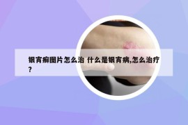 銀宵癬圖片怎么治 什么是銀宵病,怎么治療?