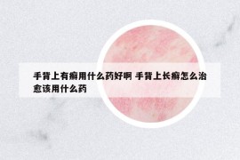 手背上有癬用什么藥好啊 手背上長癬怎么治愈該用什么藥