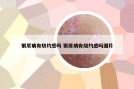 銀屑病有燒灼感嗎 銀屑病有燒灼感嗎圖片