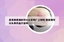 患有銀屑病的可以在塑膠廠上班嗎 銀屑病可以從事藥品行業(yè)嗎