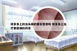 拼多多上的治頭癬的要買管用嗎 拼多多上治療銀屑病的藥膏