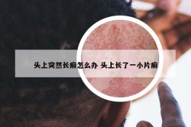頭上突然長(zhǎng)癬怎么辦 頭上長(zhǎng)了一小片癬