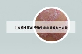 牛皮癬中醫(yī)叫 專治牛皮皮癬偏方土方法