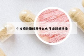 牛皮癬洗澡時(shí)用什么水 牛皮膚癬洗澡