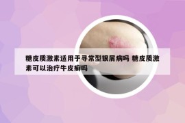 糖皮質(zhì)激素適用于尋常型銀屑病嗎 糖皮質(zhì)激素可以治療牛皮癬嗎