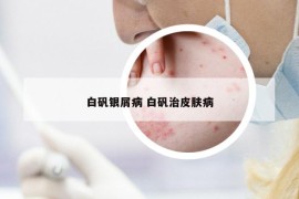 白礬銀屑病 白礬治皮膚病