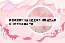 銀屑病型關(guān)節(jié)炎化驗(yàn)檢查項(xiàng)目 銀屑病型關(guān)節(jié)炎化驗(yàn)檢查項(xiàng)目是什么