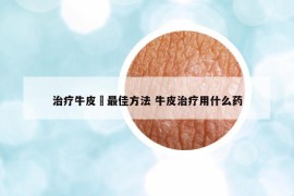治療牛皮廯最佳方法 牛皮治療用什么藥
