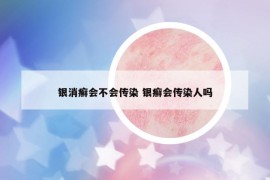 銀消癬會(huì)不會(huì)傳染 銀癬會(huì)傳染人嗎