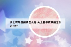 頭上有牛皮癬該怎么辦 頭上有牛皮病癬怎么治療好