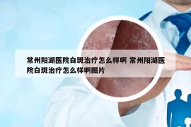 常州陽湖醫(yī)院白斑治療怎么樣啊 常州陽湖醫(yī)院白斑治療怎么樣啊圖片
