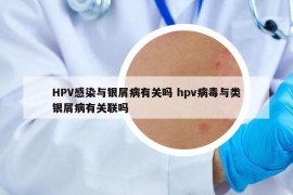 HPV感染與銀屑病有關(guān)嗎 hpv病毒與類銀屑病有關(guān)聯(lián)嗎