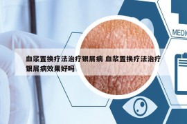 血漿置換療法治療銀屑病 血漿置換療法治療銀屑病效果好嗎