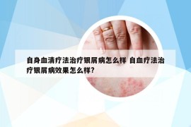自身血清療法治療銀屑病怎么樣 自血療法治療銀屑病效果怎么樣?