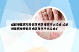 成都哪里醫(yī)院看銀屑病正規(guī)醫(yī)院比較好 成都哪里醫(yī)院看銀屑病正規(guī)醫(yī)院比較好的