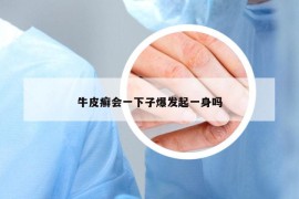 牛皮癬會一下子爆發(fā)起一身嗎