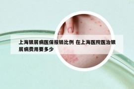 上海銀屑病醫(yī)保報(bào)銷(xiāo)比例 在上海醫(yī)院醫(yī)治銀屑病費(fèi)用要多少