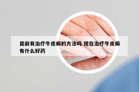 目前有治療牛皮癬的方法嗎 現(xiàn)在治療牛皮癬有什么好藥