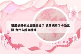銀屑病摸卡泊三醇越紅了 銀屑病用了卡泊三醇 為什么越來越癢