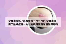全身發(fā)癢抓了起紅疙瘩一片一片的 全身發(fā)癢抓了起紅疙瘩一片一片的用海南米酒治得好嗎