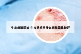 牛皮癬滋潤油 牛皮膚癬用什么潤膚霜比較好