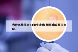 為什么維生素b1治牛皮癬 銀屑病吃維生素b1