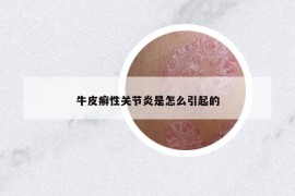 牛皮癬性關(guān)節(jié)炎是怎么引起的