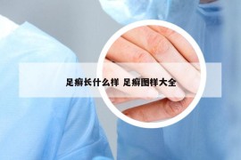 足癬長(zhǎng)什么樣 足癬圖樣大全