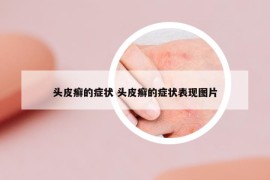 頭皮癬的癥狀 頭皮癬的癥狀表現(xiàn)圖片