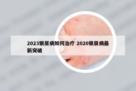2023銀屑病如何治療 2020銀屑病最新突破
