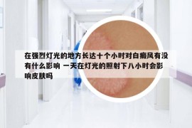 在強烈燈光的地方長達(dá)十個小時對白癜風(fēng)有沒有什么影響 一天在燈光的照射下八小時會影響皮膚嗎