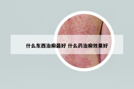 什么東西治癬最好 什么藥治癬效果好