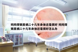 媽媽得銀屑病二十幾年身體還是很好 媽媽得銀屑病二十幾年身體還是很好怎么辦