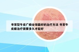 尋常型牛皮廣癬全球最好的治療方法 尋常牛皮廨治療需要多久才能好