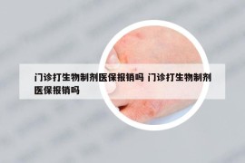 門診打生物制劑醫(yī)保報(bào)銷嗎 門診打生物制劑醫(yī)保報(bào)銷嗎