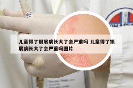 兒童得了銀屑病長(zhǎng)大了會(huì)嚴(yán)重嗎 兒童得了銀屑病長(zhǎng)大了會(huì)嚴(yán)重嗎圖片