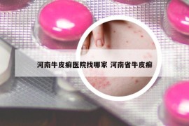 河南牛皮癬醫(yī)院找哪家 河南省牛皮癬