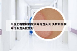 頭皮上有銀屑病應(yīng)該用啥洗頭膏 頭皮銀屑病用什么洗頭比較好