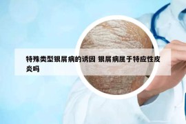 特殊類型銀屑病的誘因 銀屑病屬于特應(yīng)性皮炎嗎