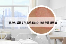 紋身以后得了牛皮癬怎么辦 紋身導(dǎo)致銀屑病