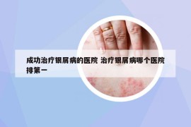 成功治療銀屑病的醫(yī)院 治療銀屑病哪個醫(yī)院排第一