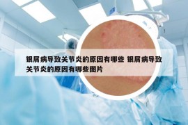 銀屑病導致關節(jié)炎的原因有哪些 銀屑病導致關節(jié)炎的原因有哪些圖片