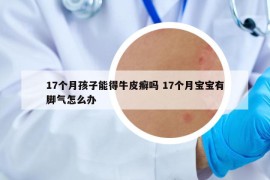 17個(gè)月孩子能得牛皮癬嗎 17個(gè)月寶寶有腳氣怎么辦