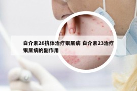 白介素26抗體治療銀屑病 白介素23治療銀屑病的副作用